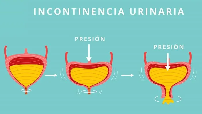 Qué es la incontinencia urinaria
