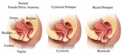 El prolapso de la vejiga ( cistocele) y prolapso del recto (rectocele)