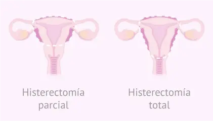 Histerectomia parcial y total